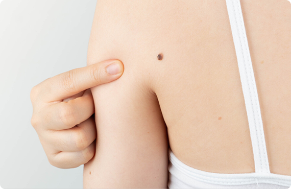 できもの(粉瘤・ほくろなど)の治療も可能 粉瘤やほくろなど、皮膚の良性腫瘍にも対応