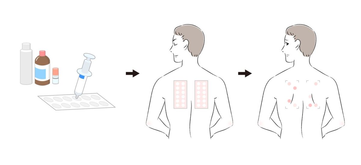 かぶれの原因を調べるパッチテスト（パネルS）