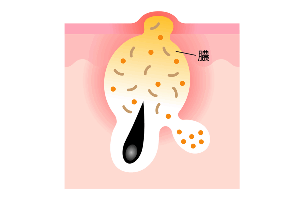 黄ニキビ