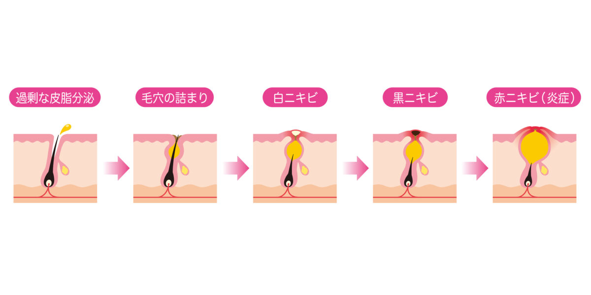 ニキビを放置するとどうなる！