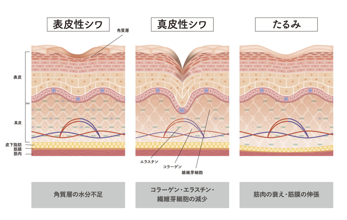 しわの種類・原因