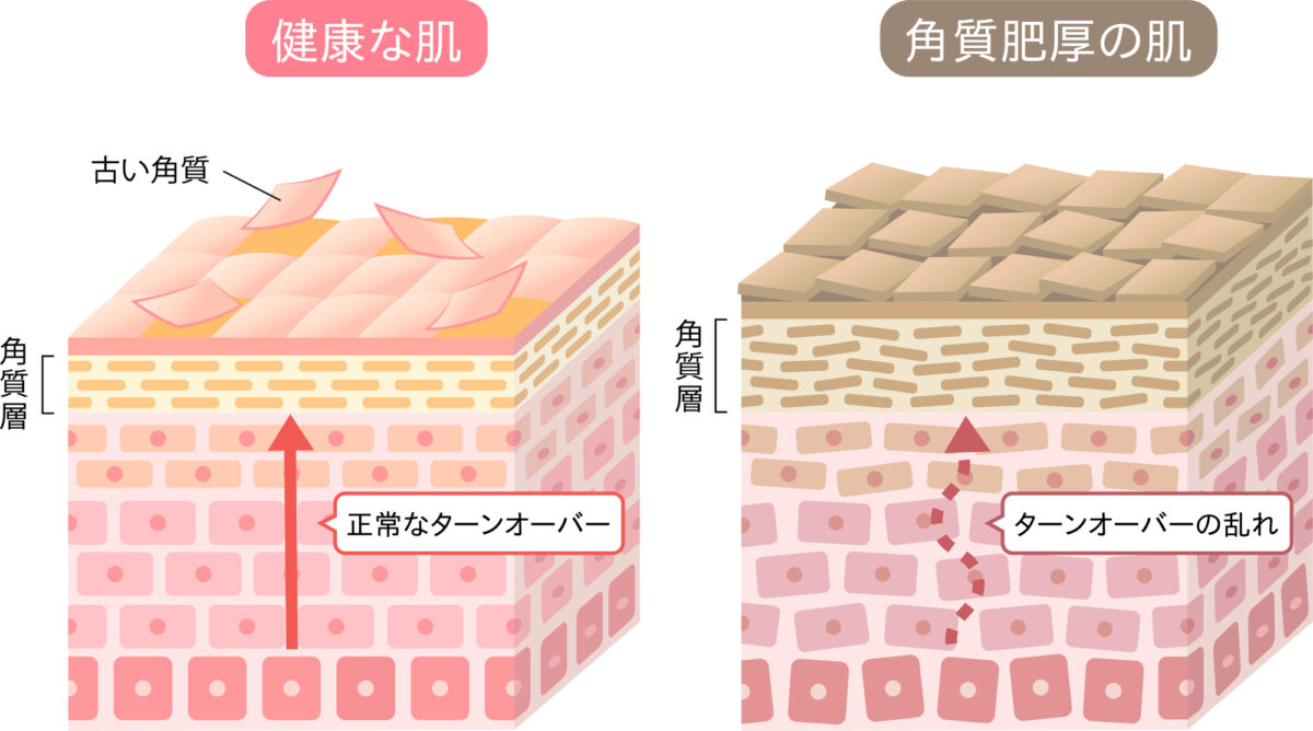 ターンオーバーとは